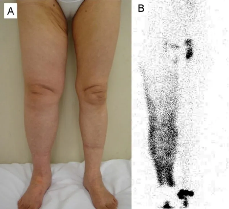 Imagen médica de dos paneles: piernas hinchadas junto a un escaneo con zonas oscuras de filtración